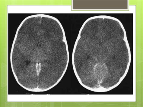 Fisiopatologia Trastornos Del Sodio Hiponatremia Hipernatremia Ppt