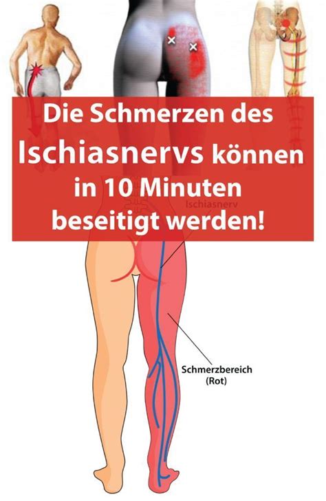 Schmerzen des Ischiasnervs können in 10 Minuten beseitigt werden