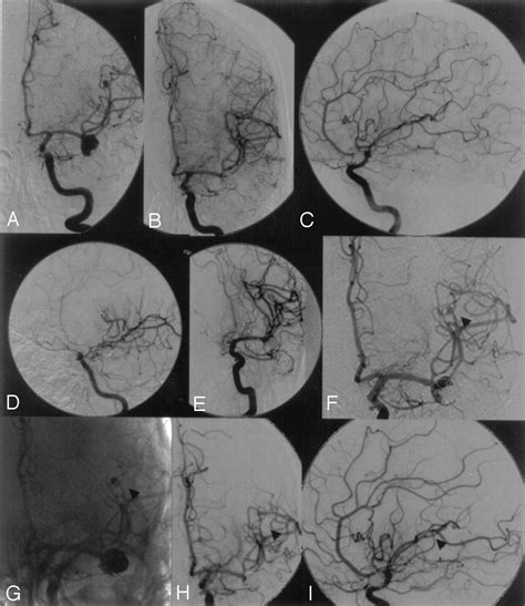 Middle Cerebral Artery Angiogram