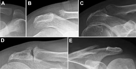 Severe Acromioclavicular Joint Osteoarthritis