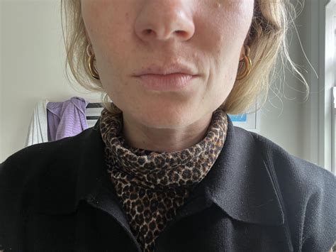 Lower half of face deteriorating rapidly (f31) What treatments will