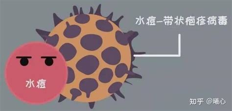 痛起来要命的带状疱疹“缠腰龙”，该如何治？ 知乎