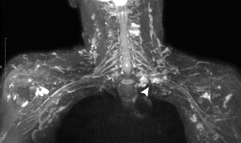 MR Neurography Of Brachial Plexus At 3 0 T With Robust Fat And Blood