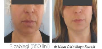 Ultraskin Ii Hifu Nowej Generacji