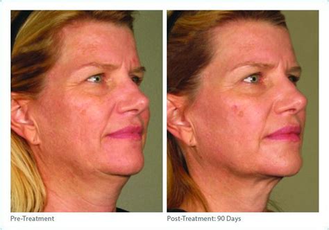 Combining Voluma And Ultherapy For The Ultimate Non Surgical Facelift