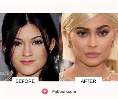 Kylie Jenner Plastic Surgery Before And After Images 2022 Fabbon