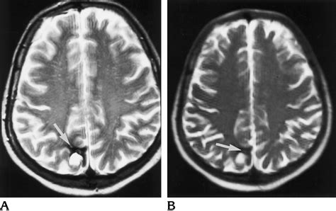 Right Parietal Lobe Hemorrhagic Infarct Containing Hemosiderin A Download Scientific Diagram