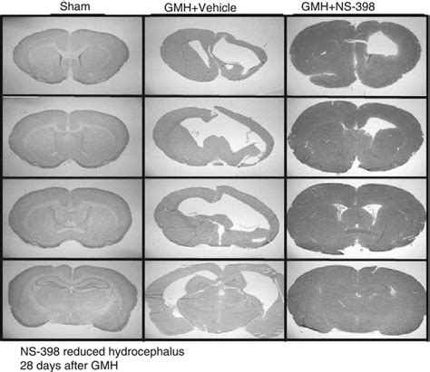 Germinal Matrix Brain