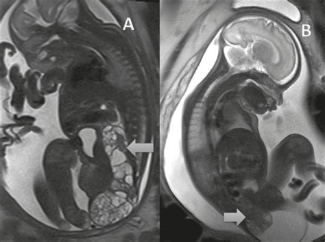 SciELO Brasil Evaluation Of The Fetal Abdomen By Magnetic Resonance