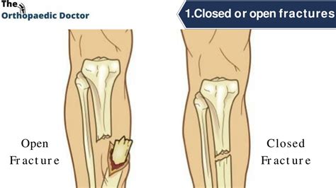 PPT - 5 common complex fracture injuries PowerPoint Presentation, free ...