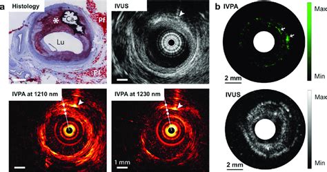 Ivpa Ivus Imaging Of Lipid Laden Atherosclerotic Plaque A Ivpa Ivus Download Scientific