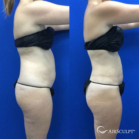 Pin On Airsculpt® Before And After Elite Body Sculpture