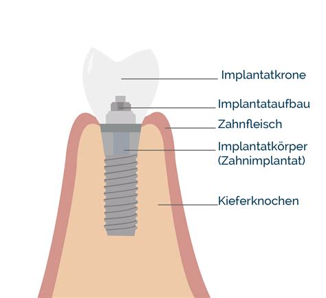 Zahnimplantate Das Moderne Verfahren Bei Zahnprothetik