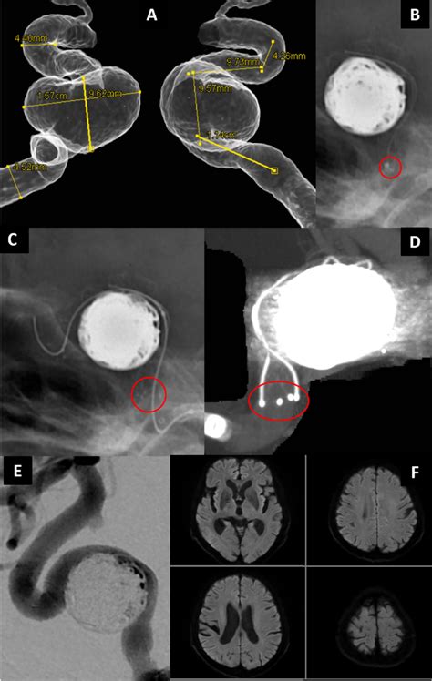 Case Preoperative Three Dimensional Digital Subtraction Angiography