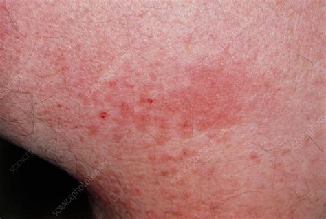 Lichen Planus Skin Rash