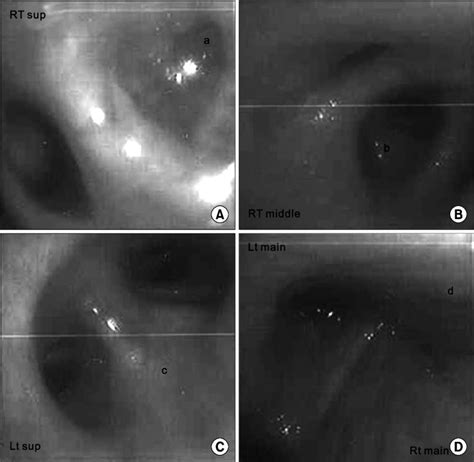 Pre And Post Fistulectomy Bronchoscopic Finding A Total Obstruction