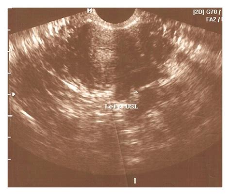 Deeply Infiltrating Endometriotic Lesion Of The Right Uterosacral