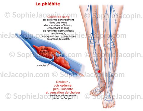 PHLÉBITE illustration medicale Sophie Jacopin