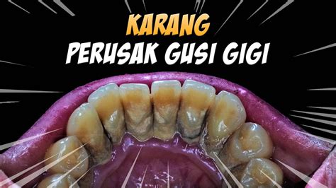 gusi  gigi jadi rusak  karang gigi youtube