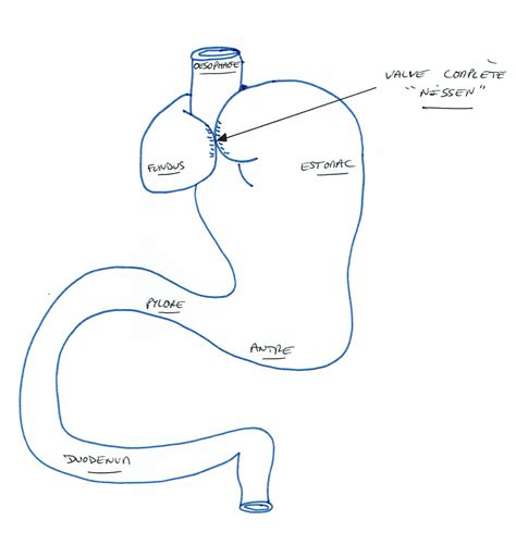 Fundoplicature Reflux Gastro Oesophagien Bordeaux Chirurgie