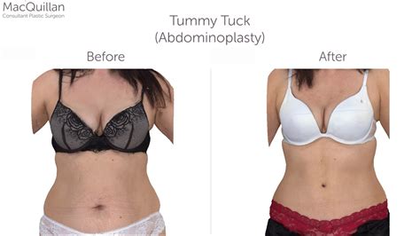 Tummy Tuck Surgery Youtube