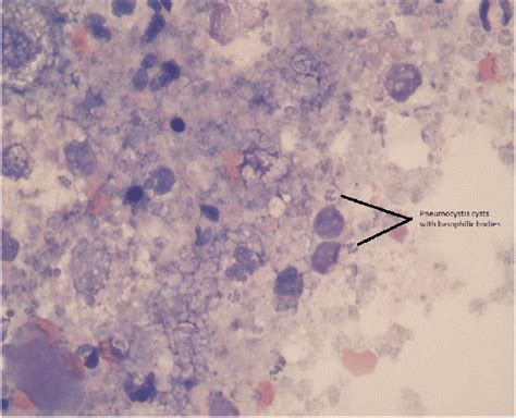 Cytology From The Bronchoalveolar Lavage Demonstrating Multiple Download Scientific Diagram