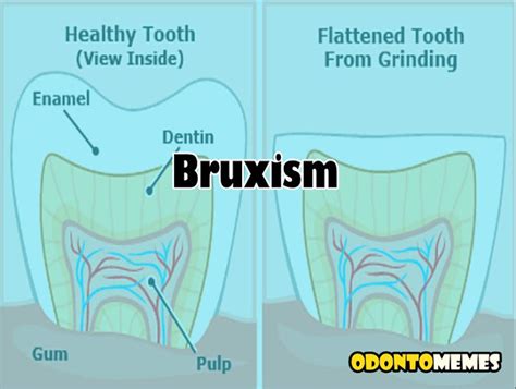 Bruxism The Silent Damage Odontomemes