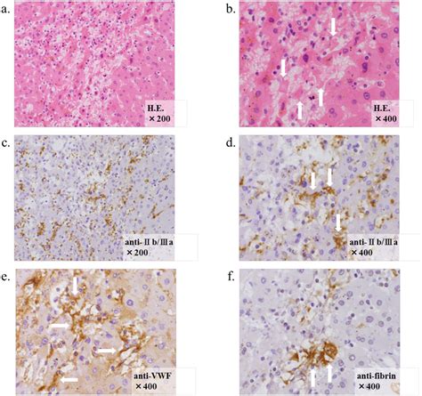 Immunohistochemical Analysis Of Liver Specimens In Patients With Download Scientific Diagram