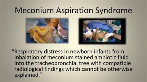 Meconium stained amniotic fluid aspiration syndrome