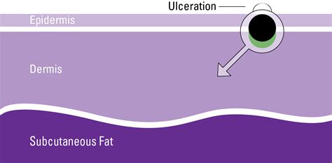 Stage III Melanoma - AIM at Melanoma Foundation