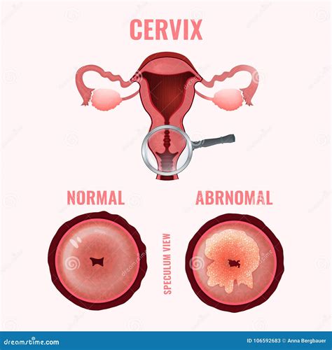 Cervicaal Kankerbeeld Vector Illustratie Illustration Of Gynaecoloog