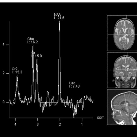 Magnetic Resonance Spectroscopy Of A Patient Carrying A Pdha Mutation