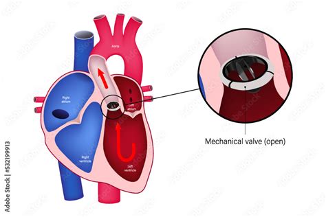 Aortic Valve Replacement With Mechanical Valve Close Up Of Closed