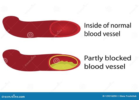 Healthy and Blocked Blood Vessels Stock Vector - Illustration of ...