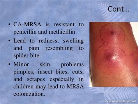 Mrsa