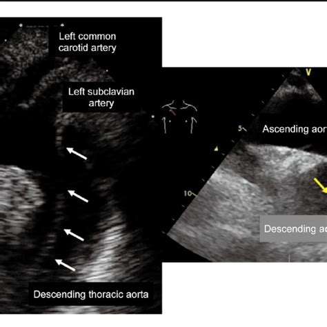 Comprehensive Assessment of Paradoxical Low-Flow, Low-Gradient Severe ...