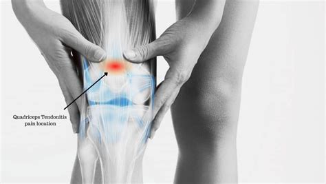 Quadriceps Tendonitis Symptoms Causes Diagnosis And Treatment