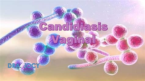 Candidiasis Vaginal En 5 Min Enfermedades Enfermería Udocz