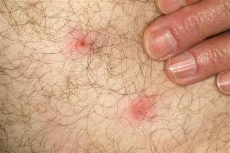 Tick Bite Pictures Symptoms What Does A Tick Bite Look 40 Off