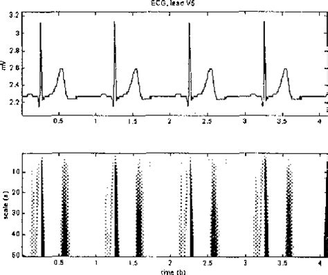 Figure From A Qrs Detection Algorithm Based On Haar Wavelet