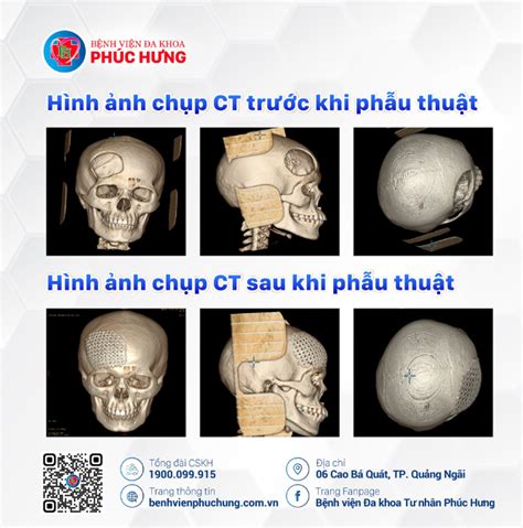 Phẫu Thuật Ghép Khuyết Sọ Trong Chấn Thương Sọ Não Với Vật Liệu Titanium Tạo Hình 3d