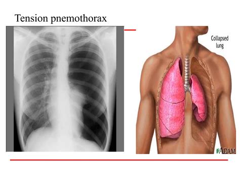 Pneumothorax For Emergency And Critical Care Nursing Students PPT