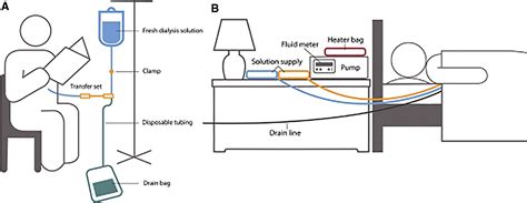 Peritoneal Dialysis Diagram