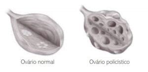 Síndrome dos Ovários Policísticos IPGO