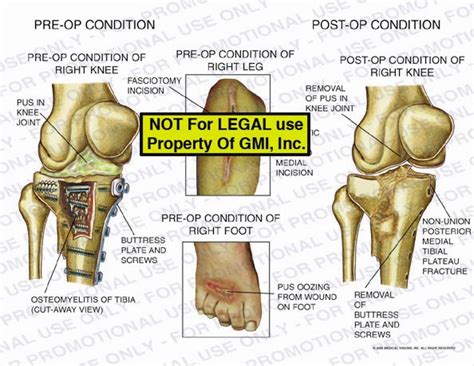 Pre Op Condition Vs Post Op Condition 95170b Generic Medical Legal Exhibits A Division Of Mvi