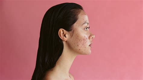 Adult Acne: Causes, Treatment, and Prevention - GoodRx