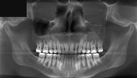 Orthopantomogram OPG Showing Severe Hypoplasia Agenesis Of The