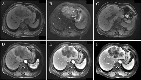 Frontiers Mri Features Of Hepatic Sarcomatoid Carcinoma Different From Hepatocellular