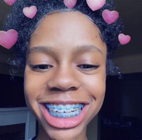 Pin By Ariana Missick On Badies Braces Colors Braces Tips Cute Braces