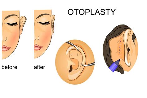 Ear Correction Surgery Cost In Turkey MCT